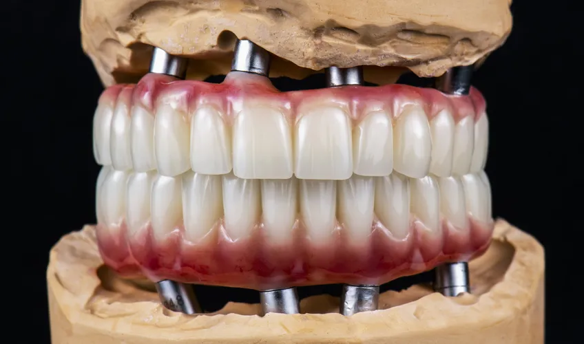 Имплантация зубов по методу All-on-4 и All-on-6 | Стоматология в Томске | INTELLY | Эликсир Премьер